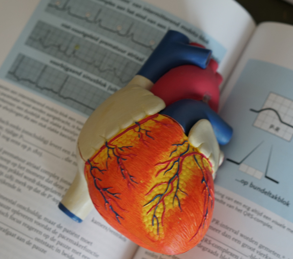 Atrial Fibrillation - Tsougos Ilias - Cardiologist